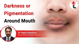 Darkness or Pigmentation Around Mouth  Darkening Around Mouth Causes  Treatment  Dermatologist [upl. by Ladnyk]