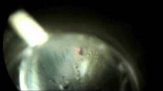 Laser Peripheral Iriditotomy to Prevent Glaucoma Part 2 [upl. by Ytsrik872]