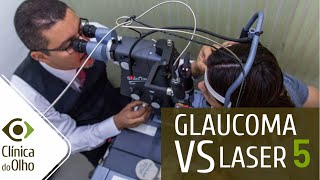 Glaucoma X Laser parte 5 Iridotomia abre o ângulo [upl. by Idnahr]