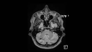 Physical Examination of Arteriovenous Fistula [upl. by Aronoel]