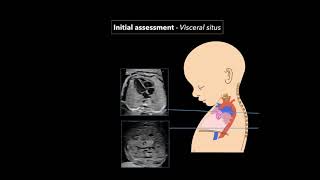 Topic 26 Intrapartum Fetal Surveillance [upl. by Evadne]