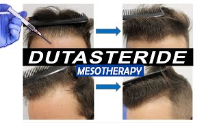 Mesotherapy with Dutasteride Injections Pros and Cons and what Results to expect [upl. by Lonier466]