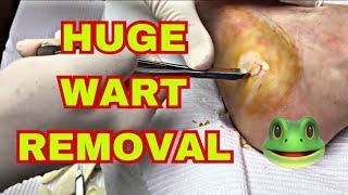 Large Wart Removal from Foot [upl. by Leirua]