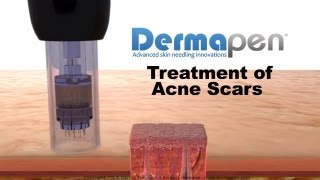 MicroNeedling for Acne Scars  Dermapen® Treatment [upl. by Hoskinson]