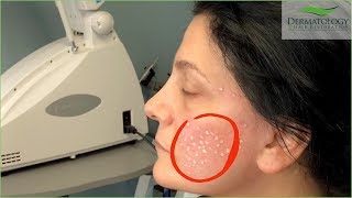 Acne Scar Removal in Los Angeles using TCA Cross Technique [upl. by Stevenson851]