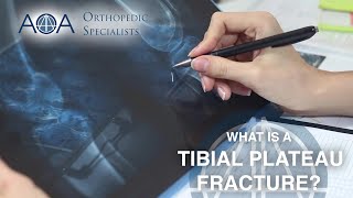 AOA Orthopedic Specialists  Tibial Plateau Fracture [upl. by Rebak]