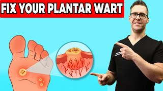 Plantar Warts Removal at Home Treatment Foot amp Toe Wart Remedies [upl. by Malia241]