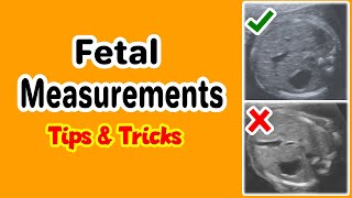 Fetal Distress Ultrasound and Heart Monitor [upl. by Naujd]