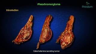 ENDOCRINE PATHOLOGY lecture 29 PHEOCHROMOCYTOMA Adrenal Medullary tumour in simple way [upl. by Guthrie18]