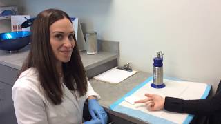 Wart Removal Using Liquid Nitrogen [upl. by Galloway]