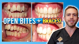 Open Bite Braces Treatment BEFORE amp AFTER [upl. by Harlene773]