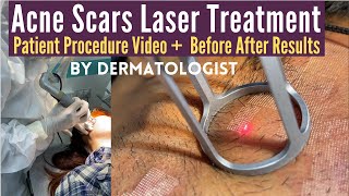 Acne Scars Laser Treatment  CO2 Laser Treatment For Acne Scars  Dermatologist  Dr Sunil Kothiwala [upl. by Anahoj548]