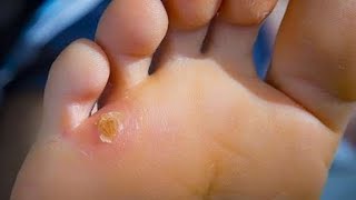 Foot and Toe Warts Best HOME Treatment [upl. by Rosse]