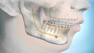 Chirurgie orthognatique ostéotomie mandibulaire [upl. by Metah]