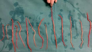 Doctors Remove 14 Roundworms From Woman [upl. by Martz889]