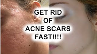 HOW TO GET RID OF ACNE SCARS  Pershii [upl. by Enelime]