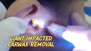 Giant Impacted Earwax Removal [upl. by Chaffee]