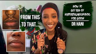 How To Get Rid Of Hyperpigmentation  Dr Hani [upl. by Crescen]