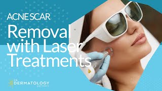 Acne Scar Removal with Laser Treatments [upl. by Vinni384]