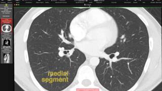 Interstitial Lung Diseases An Overview of Progression and Radiological Features [upl. by Milissent]