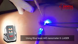 Wart removal using laser [upl. by Ambert]