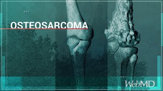 Osteosarcoma x ray appearance [upl. by Johnna]