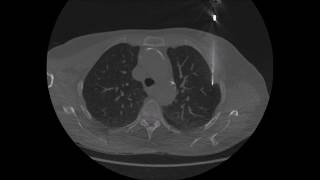 Percutaneous CTguided Lung Biopsy Procedure Technique [upl. by Primaveras749]