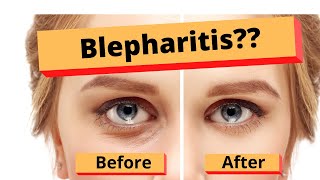 Blepharitis How to treat Blepharitis Best Home Treatment [upl. by Ecinereb]