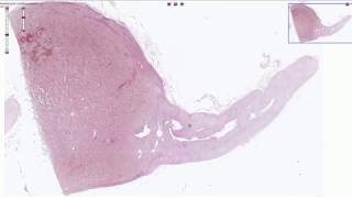 Pheochromocytoma  Histopathology [upl. by Areta689]