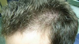 Aloe Vera Treatment For Hair Loss And Re Growth [upl. by Palua889]