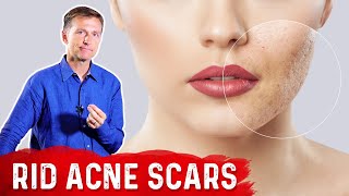 Best Way to Rid Acne Scars [upl. by Magulac559]