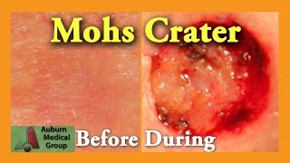 Mohs Surgery  Why it Works  McFarland Clinic [upl. by Llain111]