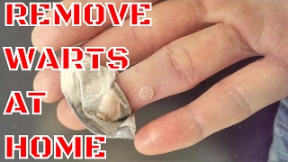 WART REMOVAL  HOW TO REMOVE WARTS AT HOME [upl. by Froemming589]