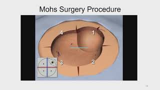 Mohs Surgery Explained Dermatology 2019 [upl. by Shaffer346]