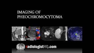 Pheochromocytoma Causes Findings Diagnosis Treatment [upl. by Yesnil]