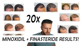 20 Finasteride and Minoxidil before and after Results NW2  NW56 [upl. by Palmira560]