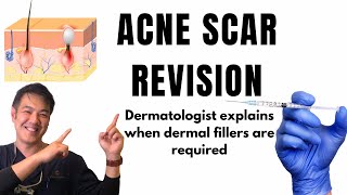 How to treat ACNE SCARS  Dermal Fillers [upl. by Tennes314]