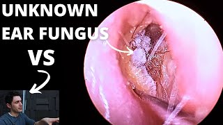 Ear Fungal Infection VS Audiologist [upl. by Yhtomiht]