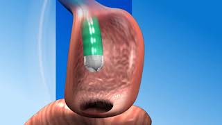 Scarless Revision Surgery after Gastric Bypass [upl. by Micco]