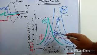 Tympanometry Impedance Audiometry [upl. by Lashar]