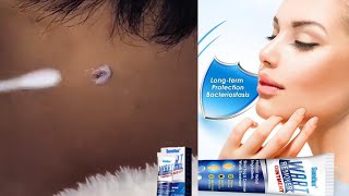 Instant Blemish Removal Gel  Sumifun Wart Remover [upl. by Llerrat]