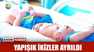 Yapışık ikizler ayrıldı [upl. by Errehs399]