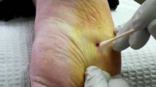 Surgical Plantar Wart Removal [upl. by Nivloc]