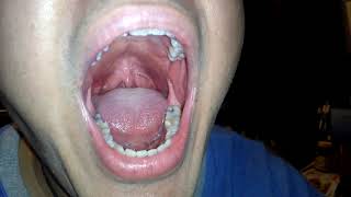 Growing White Lumps Pimples Inside Mouth On Tongue and Around Gums [upl. by Ahsekahs]