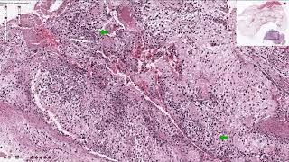 Osteosarcoma  Histopathology [upl. by Aeduj599]