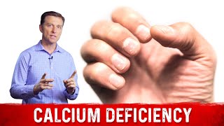 Causes amp Symptoms Of Calcium Deficiency – Dr Berg [upl. by Cave]