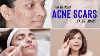 Treatments for ACNE SCARS  Dr Bindus Expert Advice [upl. by Sualocin234]