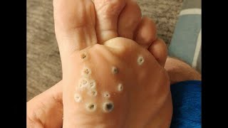 Plantar Wart Removal How to Remove Plantar Warts [upl. by Nakada941]