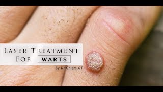 Warts removal with Laser Treatment  Dr Chiam CT [upl. by Katzir]