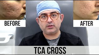 TCA Cross Acne Scar Treatment Before VS After [upl. by Brit]